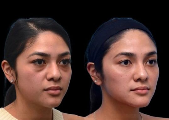 Dark Circles Treatment in Dubai