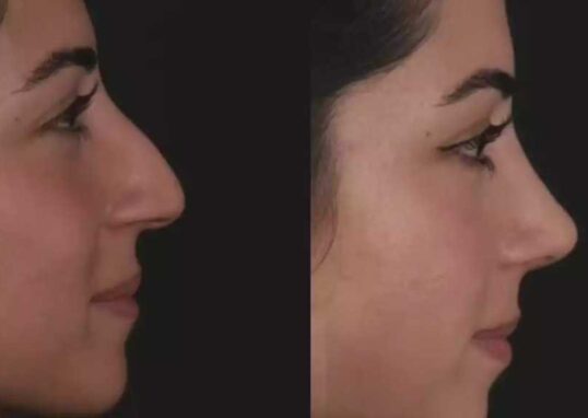 Rhinoplasty in Dubai