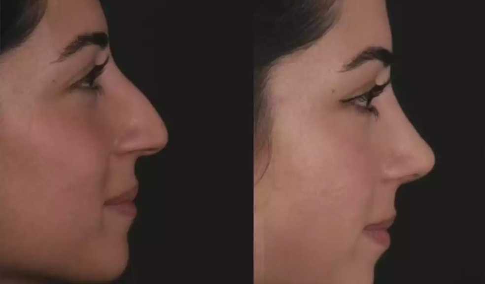 Rhinoplasty in Dubai