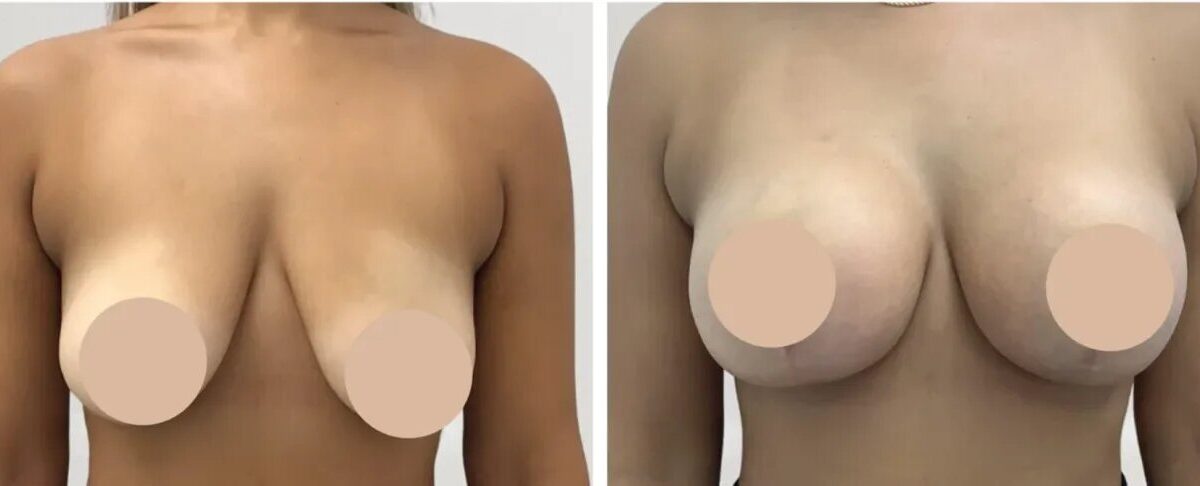 breast reduction in Dubai