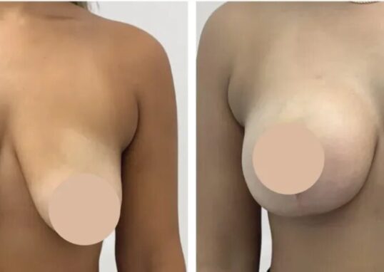 breast reduction in Dubai