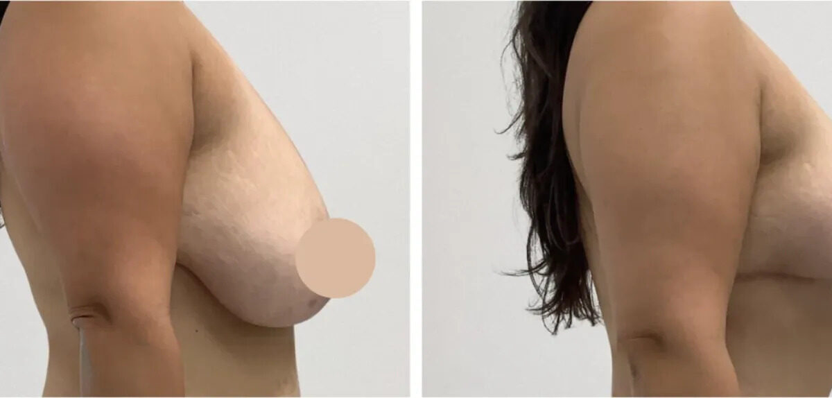 Breast Lift in Dubai
