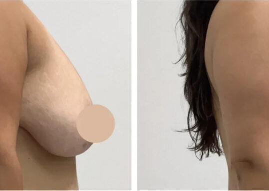 Breast Lift in Dubai