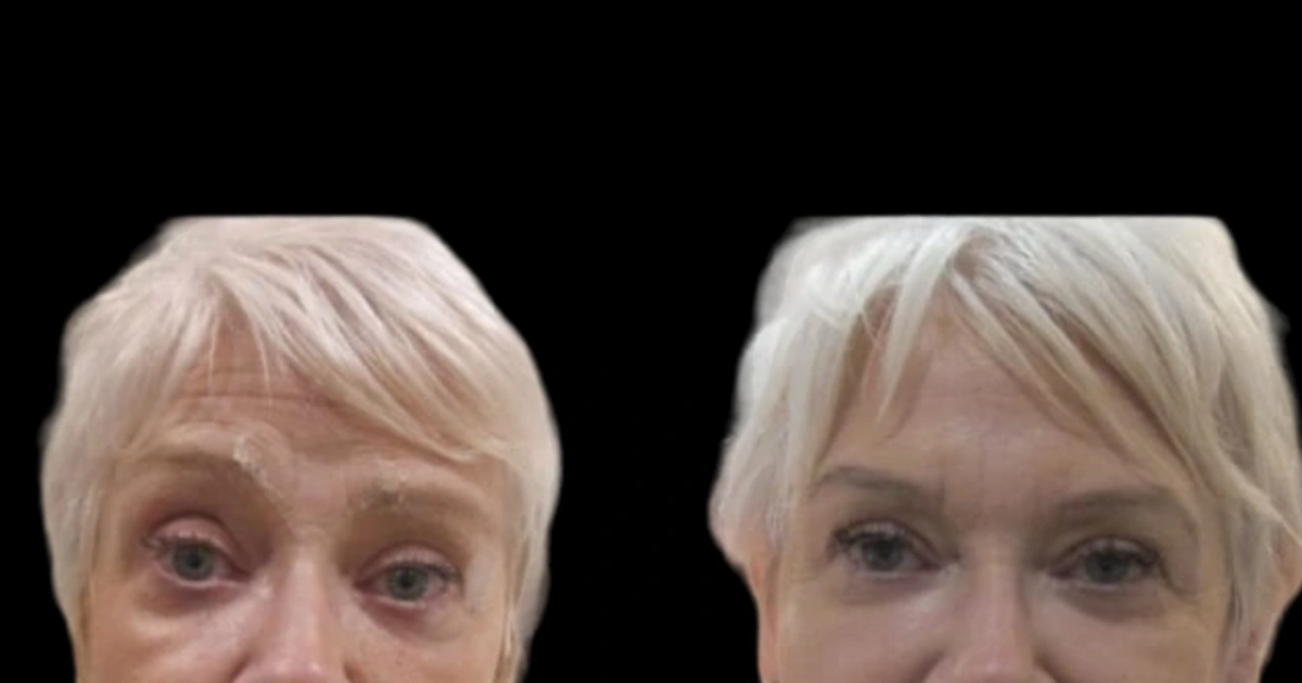 Jawline Fillers in Dubai