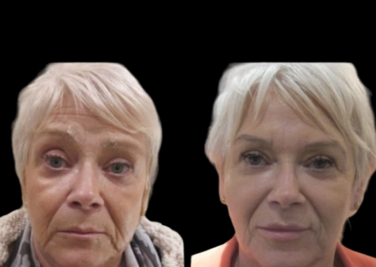 Jawline Fillers in Dubai