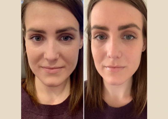 Prp Treatment in Dubai