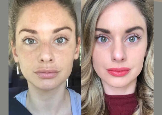 Radiofrequency (RF) Microneedling in Dubai