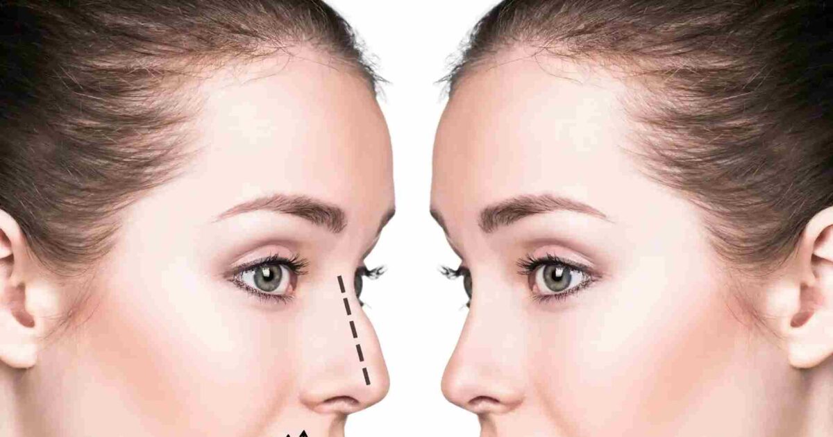 Rhinoplasty in Dubai