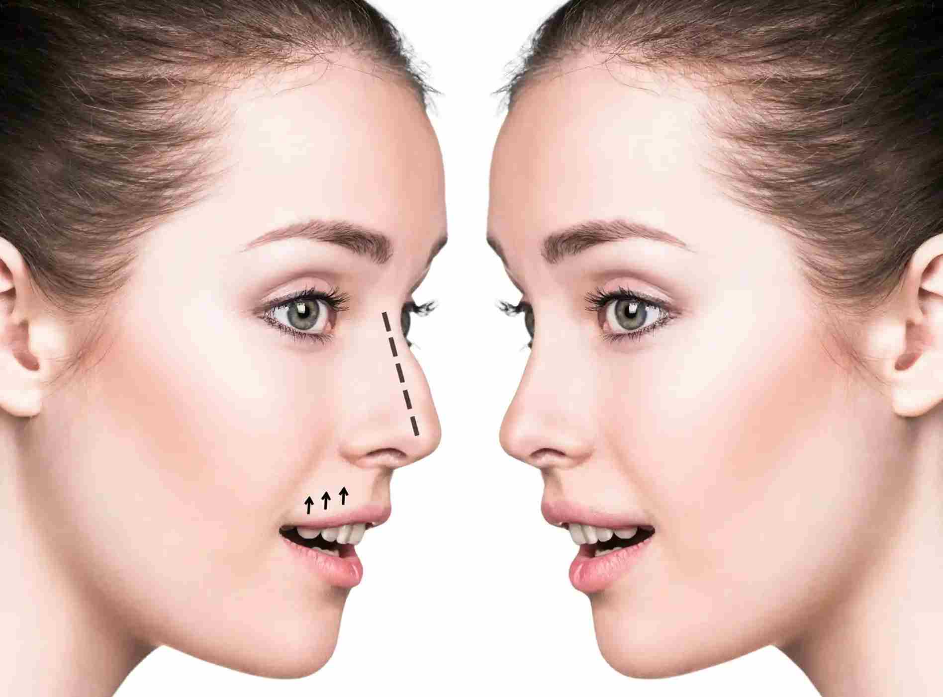 Rhinoplasty in Dubai