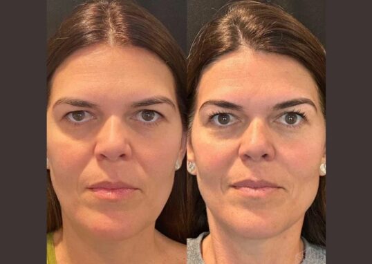 Thread lift in Dubai