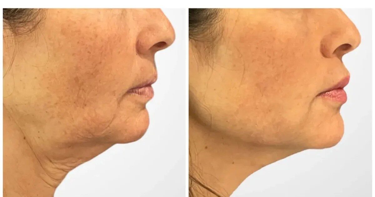 Advanced Facial Thread Lift Treatments in Dubai with Minimal Downtime