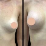 Breast augmentation in dubai