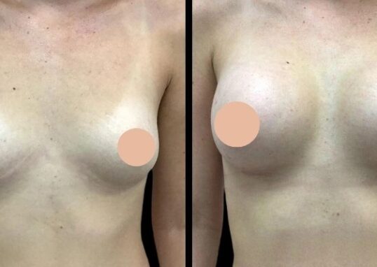 Breast augmentation in dubai