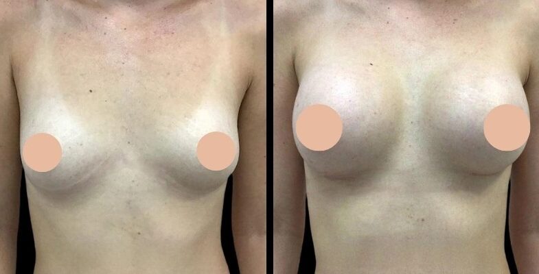 Breast Enlargement in dubai