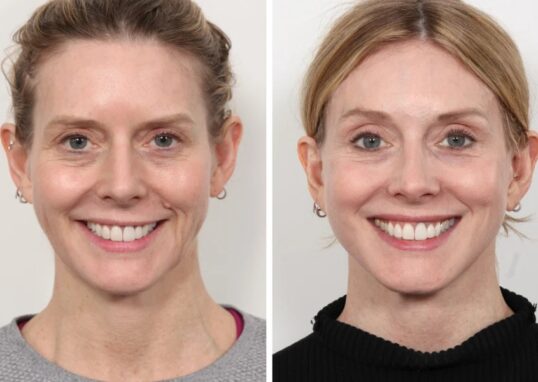 Thread lift in Dubai