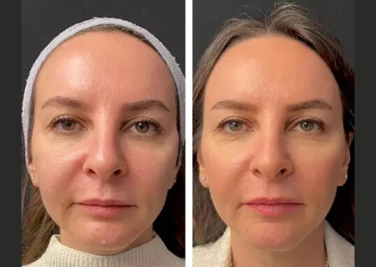 Mesotherapy in Dubai,