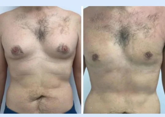 Gynecomastia in Dubai