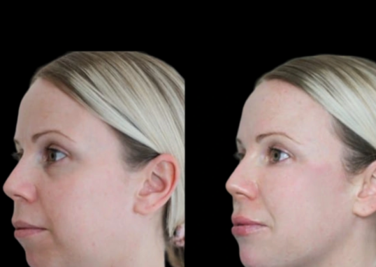 Jawline Fillers in Dubai