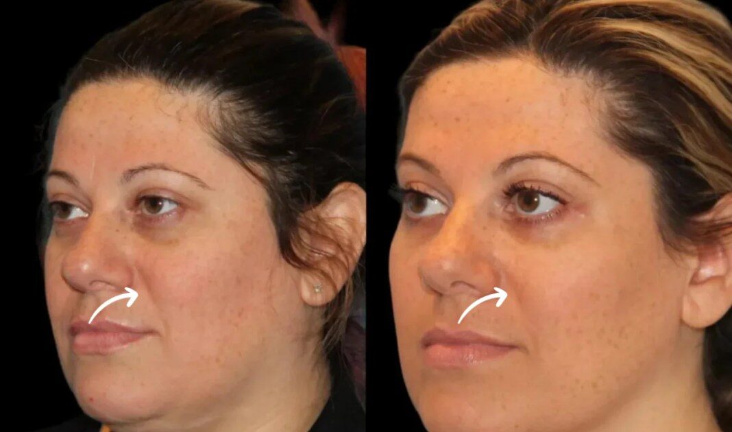 sculptra fillers in dubai