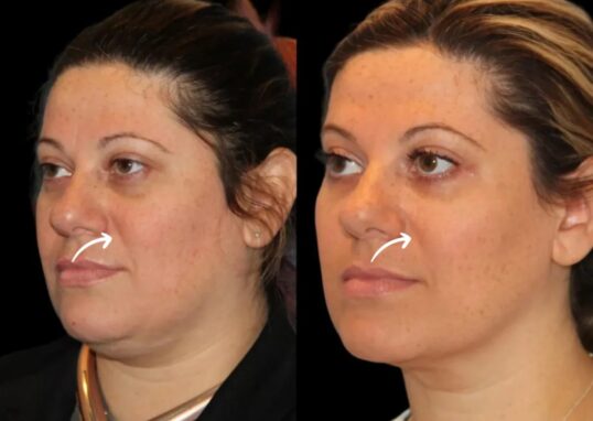 sculptra fillers in dubai