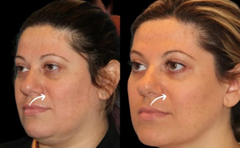 sculptra fillers in dubai