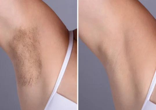 Laser hair removal in Dubai