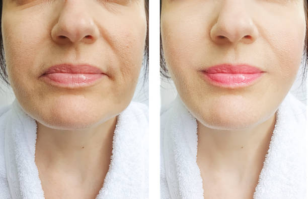 Non-surgical nose makeover