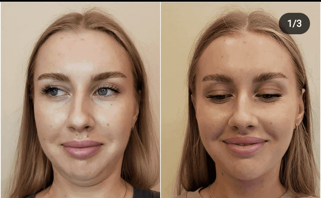 Fat Dissolving Injections in London: The Complete 2026 Guide