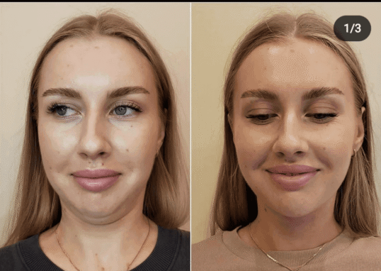 Fat Dissolving Injections in London: The Complete 2026 Guide