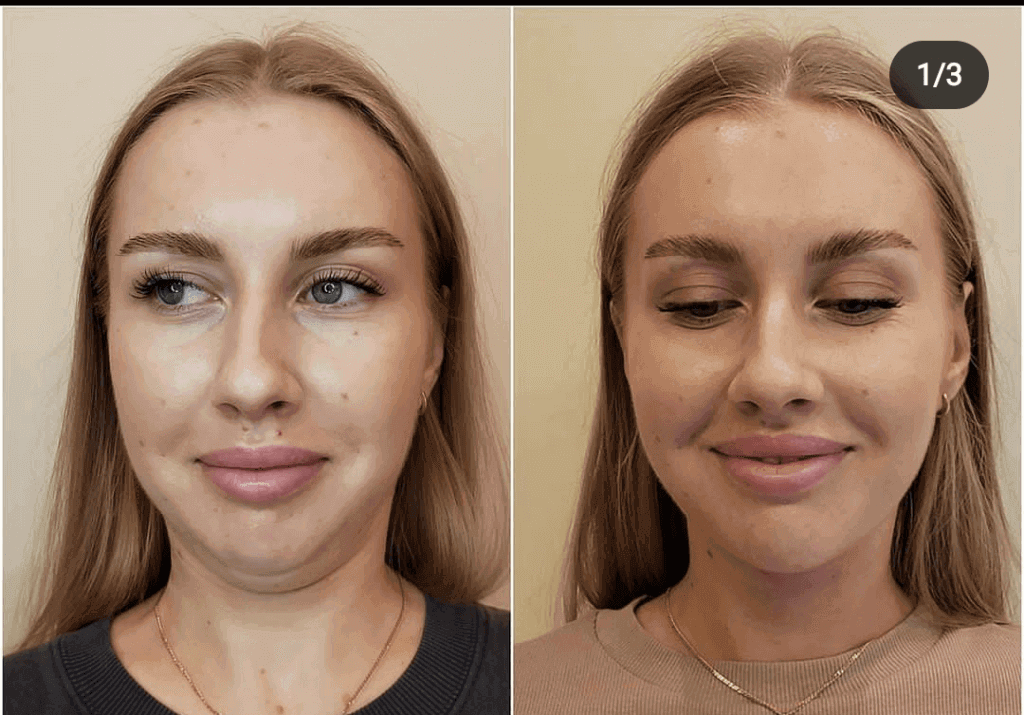 Fat Dissolving Injections in London: The Complete 2026 Guide